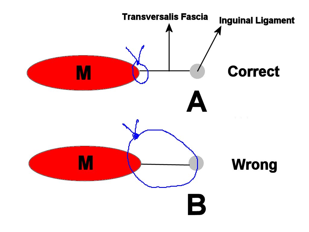 Suture method